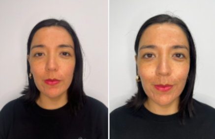 antes-y-despues-gimnasia-facial
